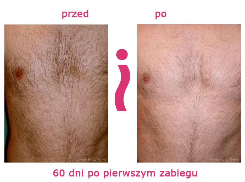 przed-i-po-klatka