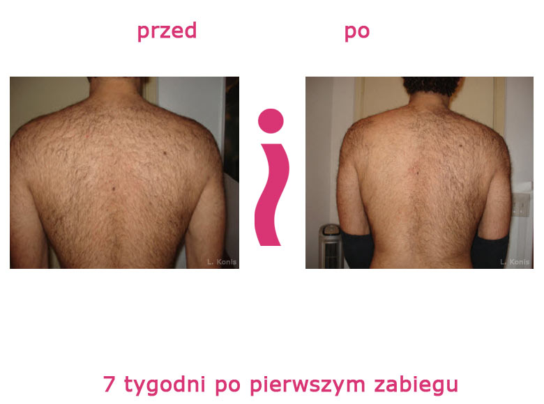 przed-i-po-plecy2