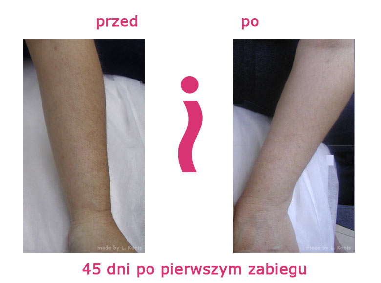 przed-i-po-przedramie